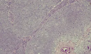 Ung thư tuyến mồ hôi hiếm gặp